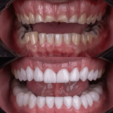 Facetas Dentárias Naturais Removíveis | SmileFix Pro [COMPRE 1 LEVE 2] - Ars importys