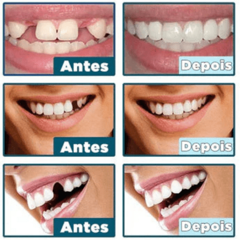 Facetas Dentárias Naturais Removíveis | SmileFix Pro [COMPRE 1 LEVE 2] - Ars importys