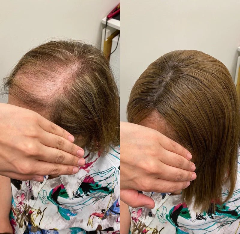 Implante Capilar Natural para Mulheres Maduras | 100% Cabelo Humano — Falhas e Alopecia - Ars importys