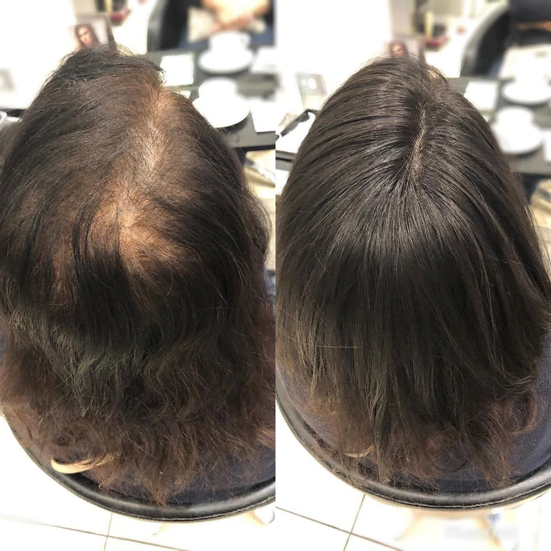 Implante Capilar Natural para Mulheres Maduras | 100% Cabelo Humano — Falhas e Alopecia - Ars importys